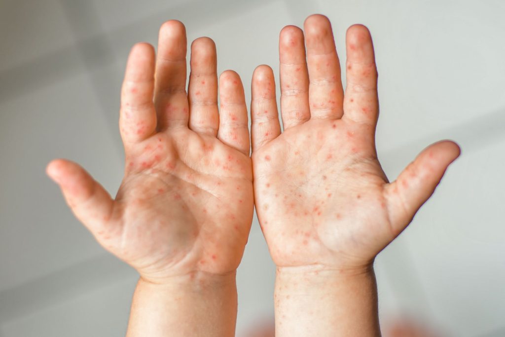 ALERT: Hand, foot & mouth disease (HFMD) spreading in Malaysia, is your child next?