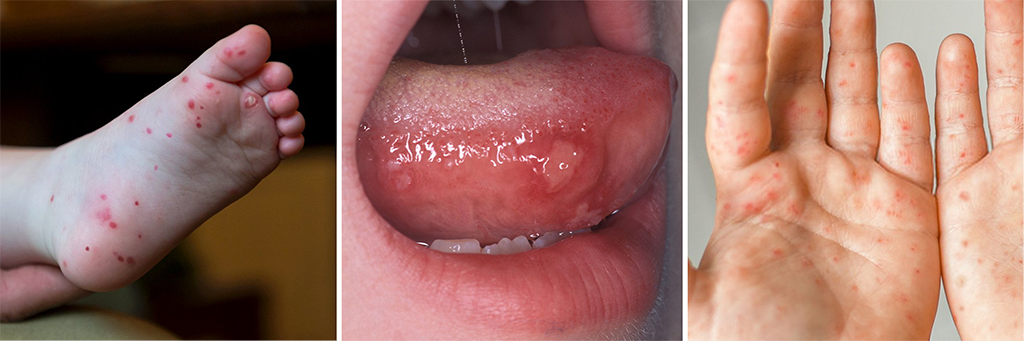 Child with visible red spots on hands, feet, and mouth showing symptoms of hand foot and mouth disease