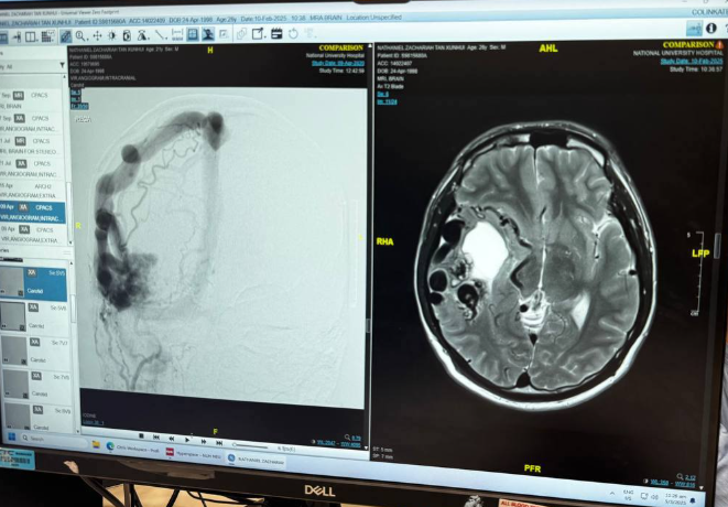 MRI scans showing Nathaniel's AVM diagnosis