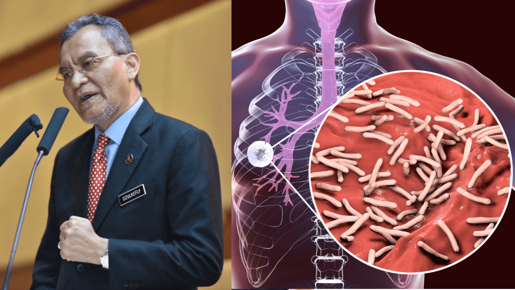 ‘Spike in TB cases not due to foreigners’: 85% of 2,571 cases involve M’sians
