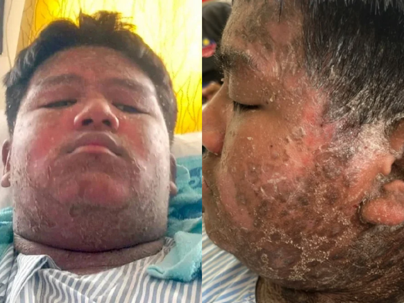 “I just want to go back to school”: M'sian teen with psoriasis hopes to sit for SPM next year